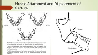 Muscle Attachment and Displacement of
fracture
 