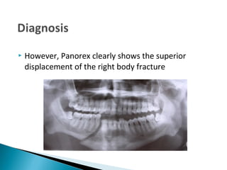 Mandible Fracture Panorex