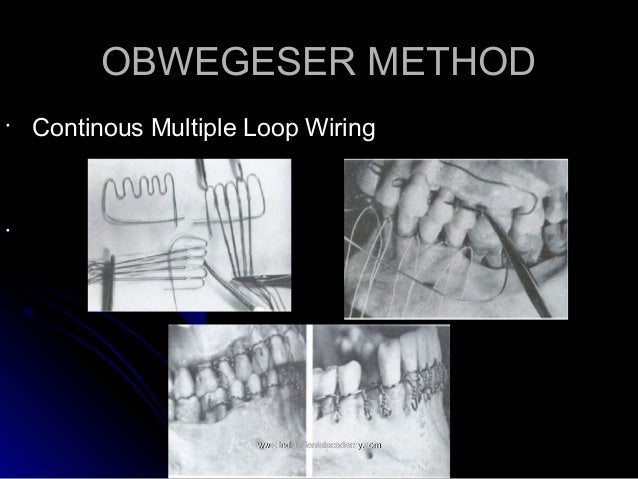 Mandibular fractures 1 / fixed orthodontic courses