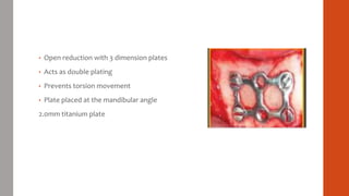 MANDIBULAR FRACTURES MANAGEMENT PROTOCO | PPTX