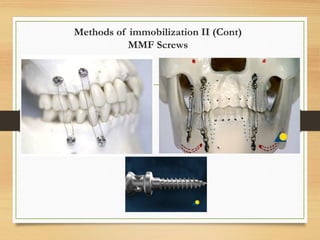 Methods of immobilization II (Cont)
MMF Screws
 
