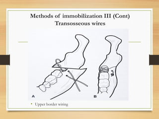 Methods of immobilization III (Cont)
Transosseous wires
• Upper border wiring
 
