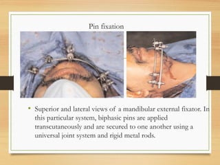Pin fixation
• Superior and lateral views of a mandibular external fixator. In
this particular system, biphasic pins are applied
transcutaneously and are secured to one another using a
universal joint system and rigid metal rods.
 