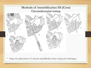 Methods of immobilization III (Cont)
Circumferential wiring
• Steps for placement of circum-mandibular wires using awl technique.
 
