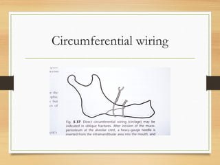 Circumferential wiring
 