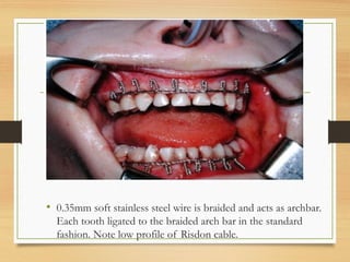 Risdon cable
• 0.35mm soft stainless steel wire is braided and acts as archbar.
Each tooth ligated to the braided arch bar in the standard
fashion. Note low profile of Risdon cable.
 