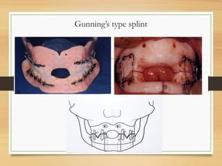 Gunning’s type splint
 