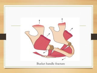Bucket handle fracture
 