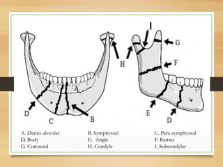 A. Dento-alveolar B. Symphyseal C. Para-symphyseal
D. Body E. Angle F. Ramus
G. Coronoid H. Condyle I. Subcondylar
 
