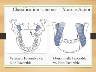 Classification schemes – Muscle Action
Vertically Favorable vs.
Non Favorable
Horizontally Favorable
vs. Non Favorable
 