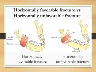Horizontally favorable fracture vs
Horizontally unfavorable fracture
Horizontally
favorable fracture
Horizontally
unfavorable fracture
 