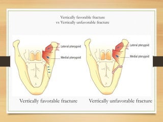 Vertically favorable fracture
vs Vertically unfavorable fracture
Vertically favorable fracture Vertically unfavorable fracture
 