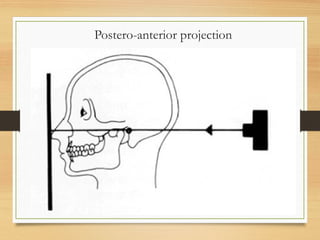 Postero-anterior projection
 