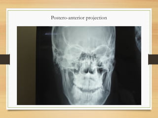 Postero-anterior projection
 