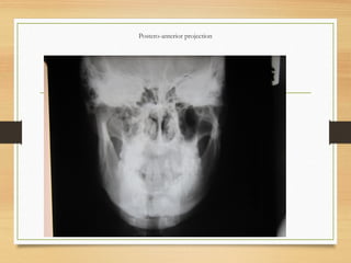 Postero-anterior projection
 