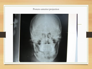 Postero-anterior projection
 