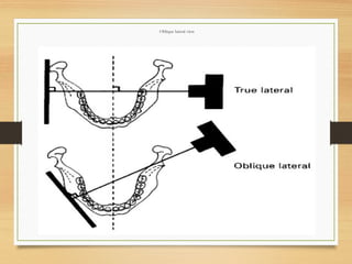 Oblique lateral view
 