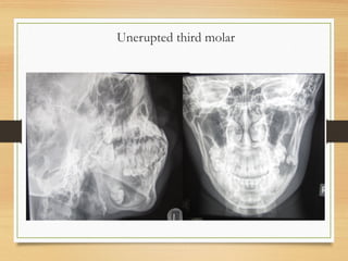 Unerupted third molar
 