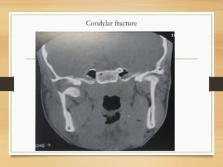 Condylar fracture
 