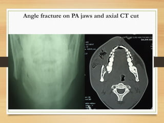 Angle fracture on PA jaws and axial CT cut
 