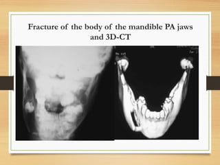 Fracture of the body of the mandible PA jaws
and 3D-CT
 