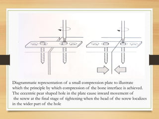 Diagrammatic representation of a small compression plate to illustrate
which the principle by which compression of the bone interface is achieved.
The eccentric pear shaped hole in the plate cause inward movement of
the screw at the final stage of tightening when the head of the screw localizes
in the wider part of the hole
 