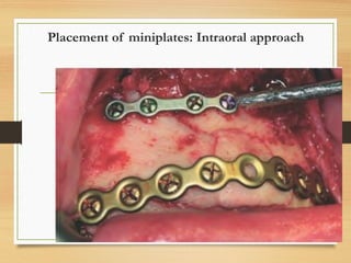 Placement of miniplates: Intraoral approach
 