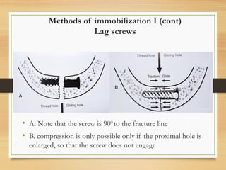 Methods of immobilization I (cont)
Lag screws
• A. Note that the screw is 900
to the fracture line
• B. compression is only possible only if the proximal hole is
enlarged, so that the screw does not engage
 