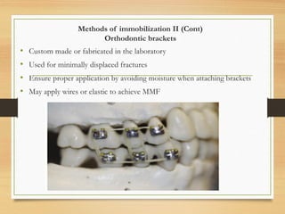 Methods of immobilization II (Cont)
Orthodontic brackets
• Custom made or fabricated in the laboratory
• Used for minimally displaced fractures
• Ensure proper application by avoiding moisture when attaching brackets
• May apply wires or elastic to achieve MMF
 
