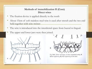 Methods of immobilization II (Cont)
Direct wires
• The fixation device is applied directly to the tooth
• About 15cm of soft stainless steel wire is used after stretch and the two end
held together with wire twister
• The wire is introduced into the interdental space from buccal to lingual.
• The upper and lower jaws were then joined.
 