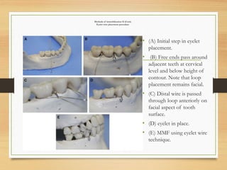 Methods of immobilization II (Cont)
Eyelet wire placement procedure
• (A) Initial step in eyelet
placement.
• (B) Free ends pass around
adjacent teeth at cervical
level and below height of
contour. Note that loop
placement remains facial.
• (C) Distal wire is passed
through loop anteriorly on
facial aspect of tooth
surface.
• (D) eyelet in place.
• (E) MMF using eyelet wire
technique.
 