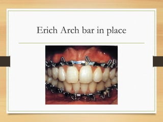 Erich Arch bar in place
 