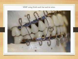 MMF using Erich arch bar and tie wires
 