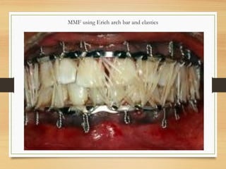 MMF using Erich arch bar and elastics
 