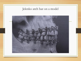 Jelenko arch bar on a model
 