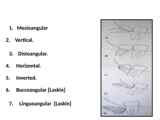 MANDIBULAR IMPACTION ,EVIDENCED BASED PPT | PPTX