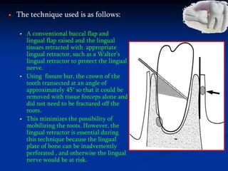 The technique used is as follows:
A conventional buccal flap and
lingual flap raised and the lingual
tissues retracted with appropriate
lingual retractor, such as a Walter’s
lingual retractor to protect the lingual
nerve.
Using fissure bur, the crown of the
tooth transected at an angle of
approximately 45° so that it could be
removed with tissue forceps alone and
did not need to be fractured off the
roots.
This minimizes the possibility of
mobilizing the roots. However, the
lingual retractor is essential during
this technique because the lingual
plate of bone can be inadvertently
perforated , and otherwise the lingual
nerve would be at risk.
 