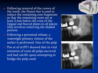 Following removal of the crown of
the tooth, the fissure bur is used to
reduce the remaining root fragments
so that the remaining roots are at
least 3 mm below the crest of the
lingual and buccal plates in all places
(this involves removing the shaded
portion.
Following a periosteal release, a
watertight primary closure of the
socket is performed. Fate of the pulp
Poe et al in1971 showed that in vital
retention of roots all pulps survived
and had calcific spurs attempting to
bridge the pulp canal
 