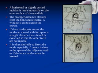 A horizontal or slightly curved
incision is made intraorally on the
outer surface of the mandible.
The mucoperiosteum is elevated
from the bone and retracted. A
window is cut to expose the
crown.
If there is adequate access, the
tooth can moved with forceps or a
straight elevator. Care should be
exercised so that the other teeth
are not injured.
It is often desirable to bisect the
tooth, especially if crown is close
to the apices of the adjacent teeth
or if the intact tooth cannot be
luxated.
 