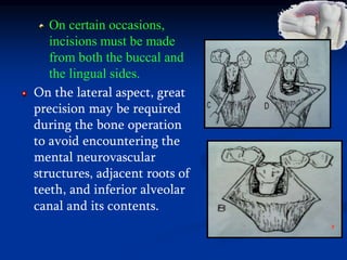 On certain occasions,
incisions must be made
from both the buccal and
the lingual sides.
On the lateral aspect, great
precision may be required
during the bone operation
to avoid encountering the
mental neurovascular
structures, adjacent roots of
teeth, and inferior alveolar
canal and its contents.
 