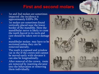 First and second molars
1st and 2nd molars are sometimes
impacted .the incidence is
approximately 0.03%-3%
1st molars are sometimes found
vertically placed near the lower
border of the mandible. Here the
mandibular nerve is likely to cross
the tooth buccal to its neck and
care should be taken not to damage
it.
mandibular molars may have to be
sectioned unless they can be
removed laterally.
The tooth is exposed and window
cut in the If the crown still cannot
be moved easily with elevator it
can also be longitudinally.
After removal of the crown, roots
are removed by inserting elevator
into the bifurcation or removing
them individually.
 