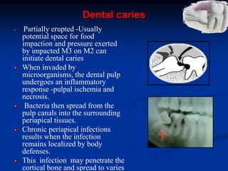 Dental caries
Partially erupted -Usually
potential space for food
impaction and pressure exerted
by impacted M3 on M2 can
initiate dental caries
When invaded by
microorganisms, the dental pulp
undergoes an inflammatory
response -pulpal ischemia and
necrosis.
Bacteria then spread from the
pulp canals into the surrounding
periapical tissues.
Chronic periapical infections
results when the infection
remains localized by body
defenses.
This infection may penetrate the
cortical bone and spread to varies
 