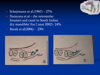 Schejtmann et al.(1967) – 27%
Narayana et.al – the retromolar
foramen and canal in South Indian
dry mandible( Eur J anat 2002)- 24%.
Burak et.al(2006) - 23%
 