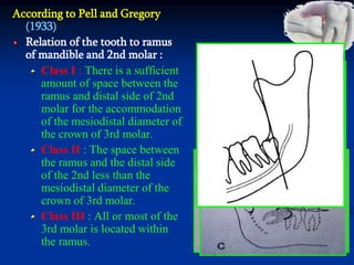 According to Pell and Gregory
(1933)
Relation of the tooth to ramus
of mandible and 2nd molar :
Class I : There is a sufficient
amount of space between the
ramus and distal side of 2nd
molar for the accommodation
of the mesiodistal diameter of
the crown of 3rd molar.
Class II : The space between
the ramus and the distal side
of the 2nd less than the
mesiodistal diameter of the
crown of 3rd molar.
Class III : All or most of the
3rd molar is located within
the ramus.
 