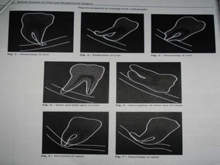 Relationship with inferior alveolar
(dental) canal
Related but not involving the canal
Separate
Adjacent
Superimposed
Seven radiological signs had been
suggested by Howe And Payton as
indicative of a close relationship
between the M3 and IAN canal.
Four of these signs were seen on
the root of the tooth and the other
three were related to changes in
the appearance of the inferior
alveolar canal.
 