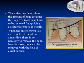 The amber line determines
the amount of bone covering
the impacted tooth which has
to be removed for applying
elevator to remove the tooth.
When the entire crown lies
above and in front of the
amber line, there is no
necessity to remove the bone.
In other cases, bone can be
removed with the help of
chisel or burs.
 
