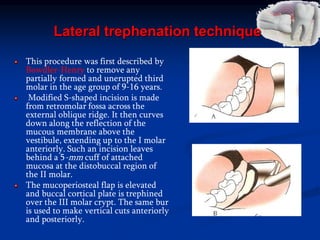 Lateral trephenation technique
This procedure was first described by
Bowdler-Henry to remove any
partially formed and unerupted third
molar in the age group of 9-16 years.
Modified S-shaped incision is made
from retromolar fossa across the
external oblique ridge. It then curves
down along the reflection of the
mucous membrane above the
vestibule, extending up to the I molar
anteriorly. Such an incision leaves
behind a 5-mm cuff of attached
mucosa at the distobuccal region of
the II molar.
The mucoperiosteal flap is elevated
and buccal cortical plate is trephined
over the III molar crypt. The same bur
is used to make vertical cuts anteriorly
and posteriorly.
 