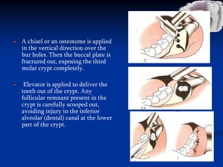 A chisel or an osteotome is applied
in the vertical direction over the
bur holes. Then the buccal plate is
fractured out, exposing the third
molar crypt completely.
Elevator is applied to deliver the
tooth out of the crypt. Any
follicular remnant present in the
crypt is carefully scooped out,
avoiding injury to the inferior
alveolar (dental) canal at the lower
part of the crypt.
 