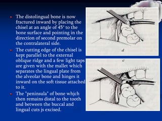 The distolingual bone is now
fractured inward by placing the
chisel at an angle of 45° to the
bone surface and pointing in the
direction of second premolar on
the contralateral side.
The cutting edge of the chisel is
kept parallel to the external
oblique ridge and a few light taps
are given with the mallet which
separates the lingual plate from
the alveolar bone and hinges it
inward on the soft tissue attached
to it.
The "peninsula" of bone whjch
then remains distal to the tooth
and between the buccal and
lingual cuts js excised.
 