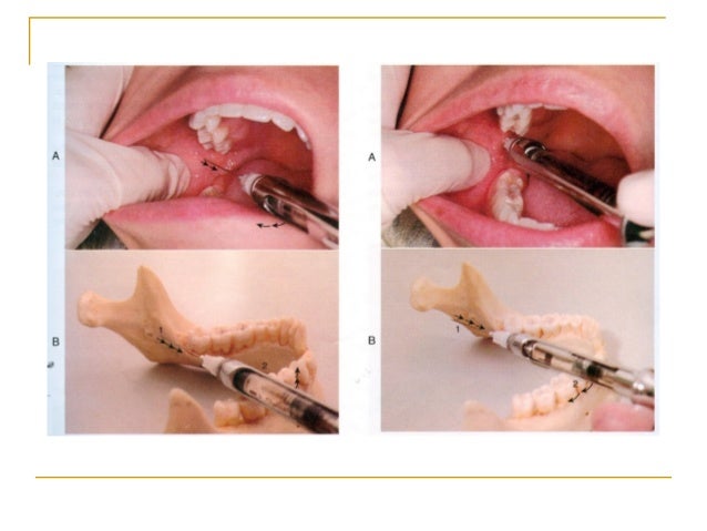 Stay Sharp With Mandibular Injection Techniques – JYVZ